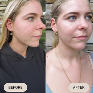 Teen Clear Complexion Kit