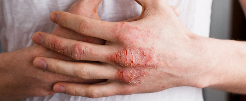 Blog - What is eczema?