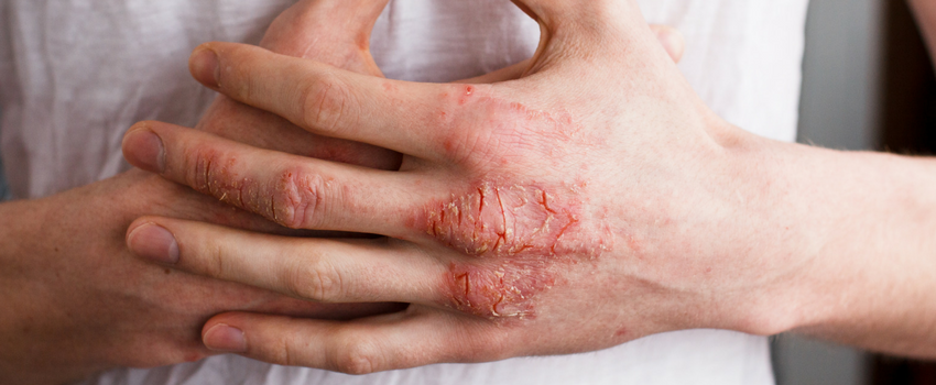 What is eczema?