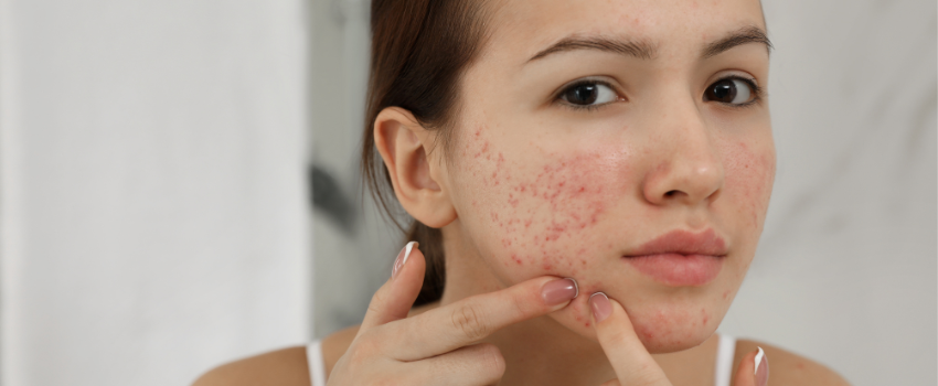Acne - causes & remedies